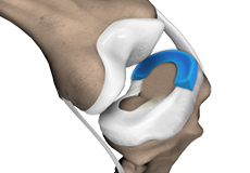 Meniscal Surgery