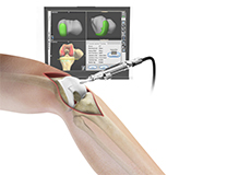 Computer Navigation for Total Knee Replacement