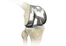 Custom-fitted Total Knee Arthroplasty