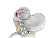 Failed Meniscus Repair