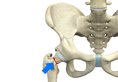 Femoral Shaft Fracture