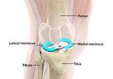 Lateral Meniscus Syndrome