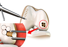 Mosaicplasty