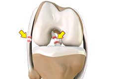 Multiligament Instability