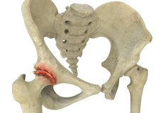 Osteoarthritis of the Hip