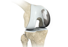 Partial Lateral Knee Replacement