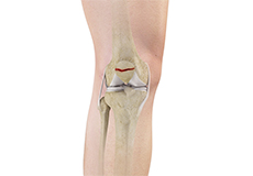 Fractures of the Patella