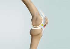 Patellar Tendinitis