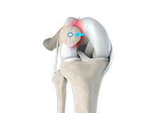 Patellar Tracking Disorder/Patellar Maltracking