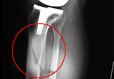 Periprosthetic Knee Fractures