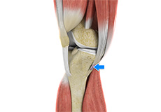 Pes Anserine Bursitis