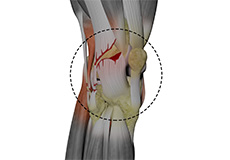 Posterolateral Instability