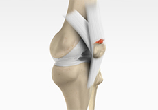 Quadriceps Tendon Rupture