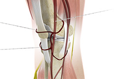 Genicular Nerve Block