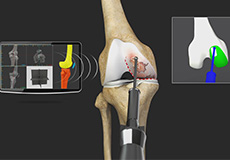 Robotic Unicondylar Knee Replacement