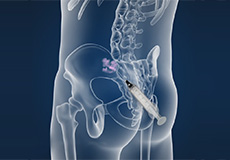 Sacroiliac Joint Injections