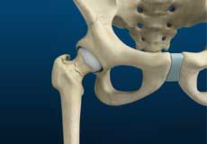 Stress Fractures of the Hip