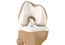 Tibial Eminence Fractures