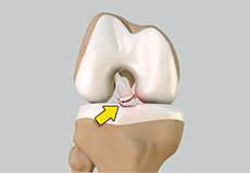 Tibial Eminence Spine Avulsion Fracture