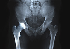 Transient Osteoporosis of the Hip