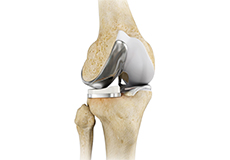 Unicompartmental/Partial Knee Replacement