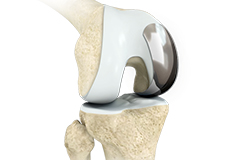 Unicondylar knee Replacement